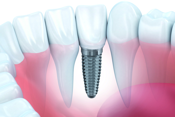 Implantologia dentale per denti belli e naturali