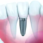 Implantologia dentale per denti belli e naturali